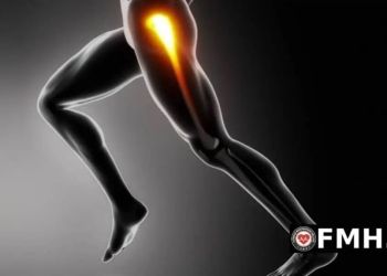 Τροχαντηρίτιδα ισχίου: Ποιες είναι οι αιτίες και ποια η θεραπεία