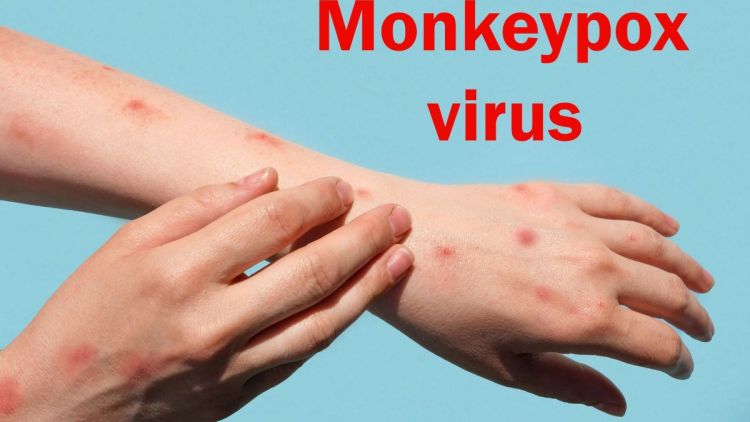 Ευλογιά των πιθήκων: Γιατί ο ΠΟΥ αποφάσισε να κηρύξει παγκόσμιο συναγερμό Ευλογιά των πιθήκων: Γιατί ο ΠΟΥ αποφάσισε να κηρύξει παγκόσμιο συναγερμό