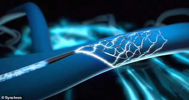 Ιστορική επέμβαση στις ΗΠΑ: Έβαλαν εμφύτευμα σε ασθενή που θα μεταβιβάζει τις σκέψεις του σε υπολογιστή Ιστορική επέμβαση στις ΗΠΑ: Έβαλαν εμφύτευμα σε ασθενή που θα μεταβιβάζει τις σκέψεις του σε υπολογιστή