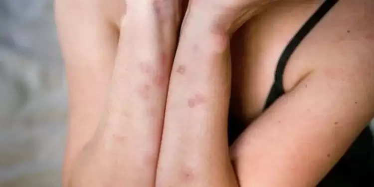 Πώς θα καταλάβετε ότι το σπίτι σας δέχεται «επίθεση» από κοριούς Πώς θα καταλάβετε ότι το σπίτι σας δέχεται «επίθεση» από κοριούς