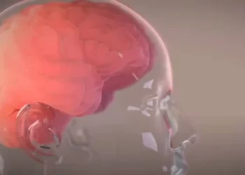 Ο Έλον Μασκ ανακοίνωσε την πρώτη επιτυχή εμφύτευση του Telepathy σε εγκέφαλο ασθενή